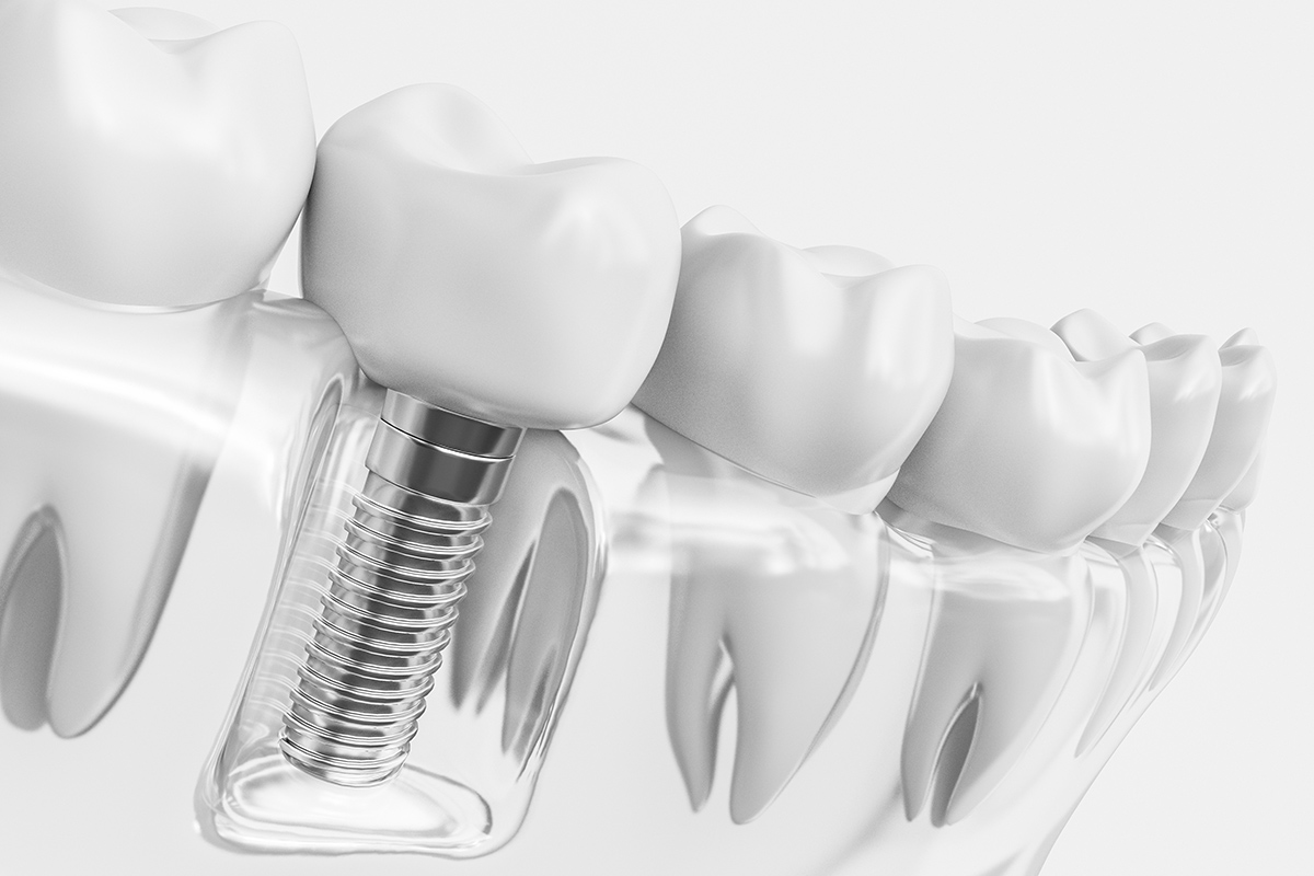 植牙系統最似真牙的好選擇